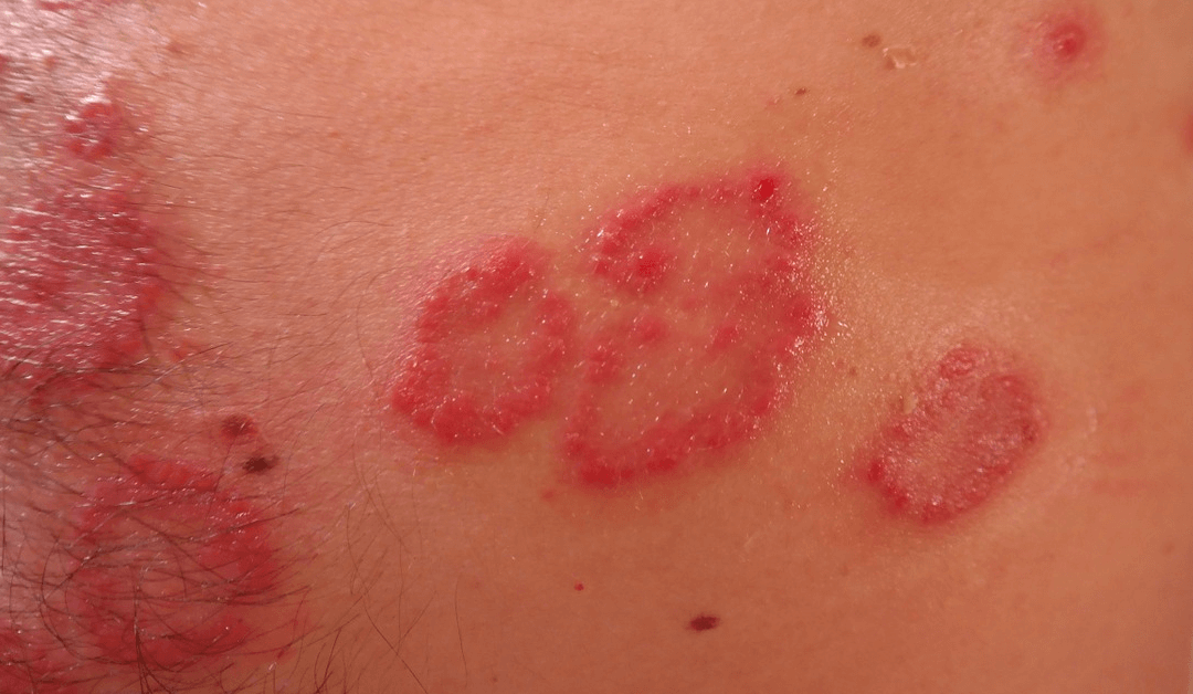 shingles pain management in Miami