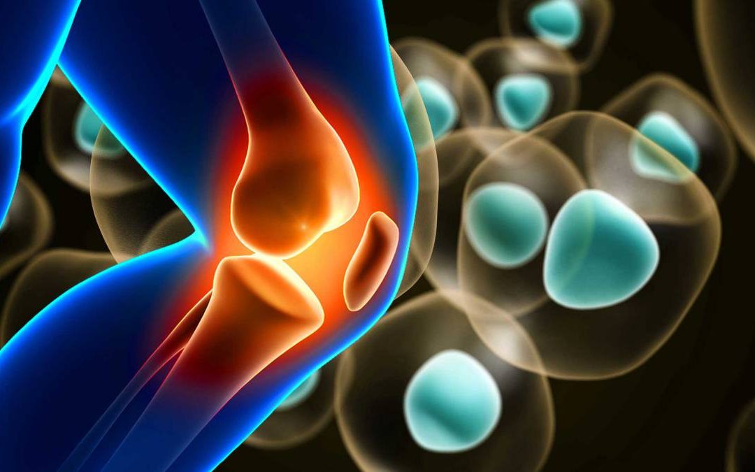 Stem Cell Therapy vs. Joint Replacement for Knee Pain