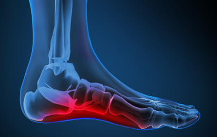 Plantar Fasciitis: A Plan to Relieve Foot Pain Using Regenerative Medicine