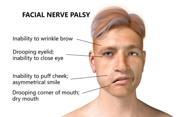 Case Report: Bell’s Palsy and Stem Cell Therapy
