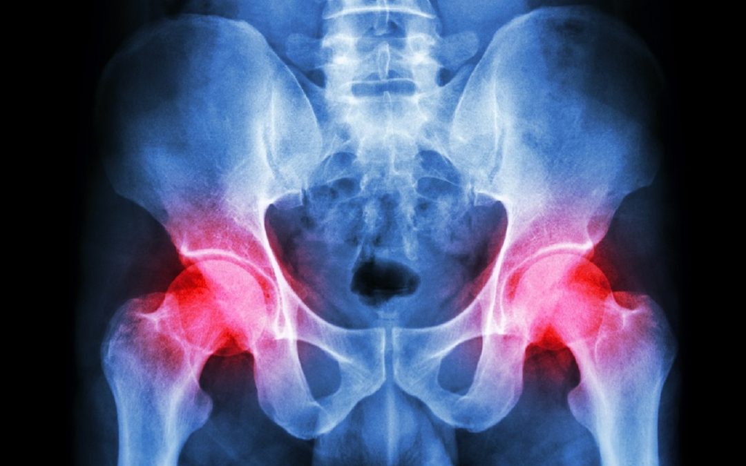 The Effectiveness of Autologous Platelet-Rich Plasma for Osteoarthritis of the Hip: A Retrospective Analysis