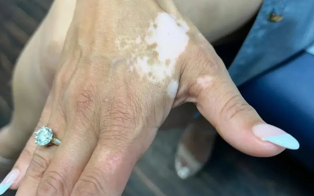 Stem Cell Therapy Offers a Possible Safe and Promising Alternative Approach for Treating Vitiligo: A Review
