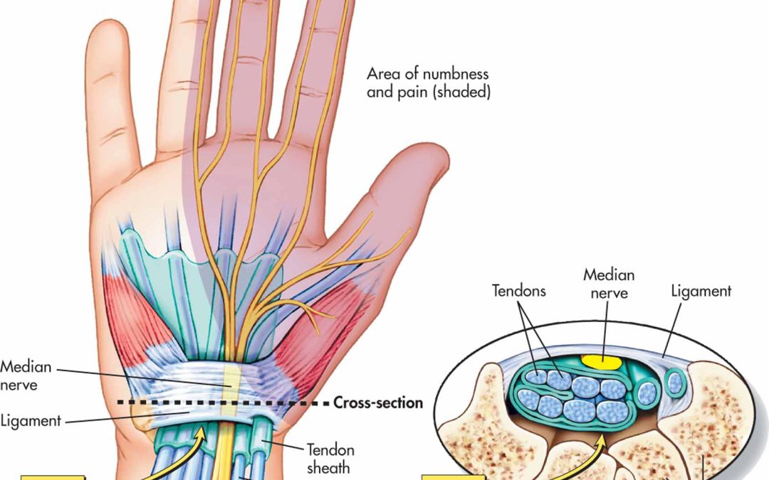 Single injection of platelet-rich plasma as a novel treatment of carpal tunnel syndrome