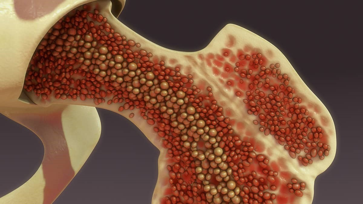 Bone Marrow Aspirate Concentrate (BMAC)