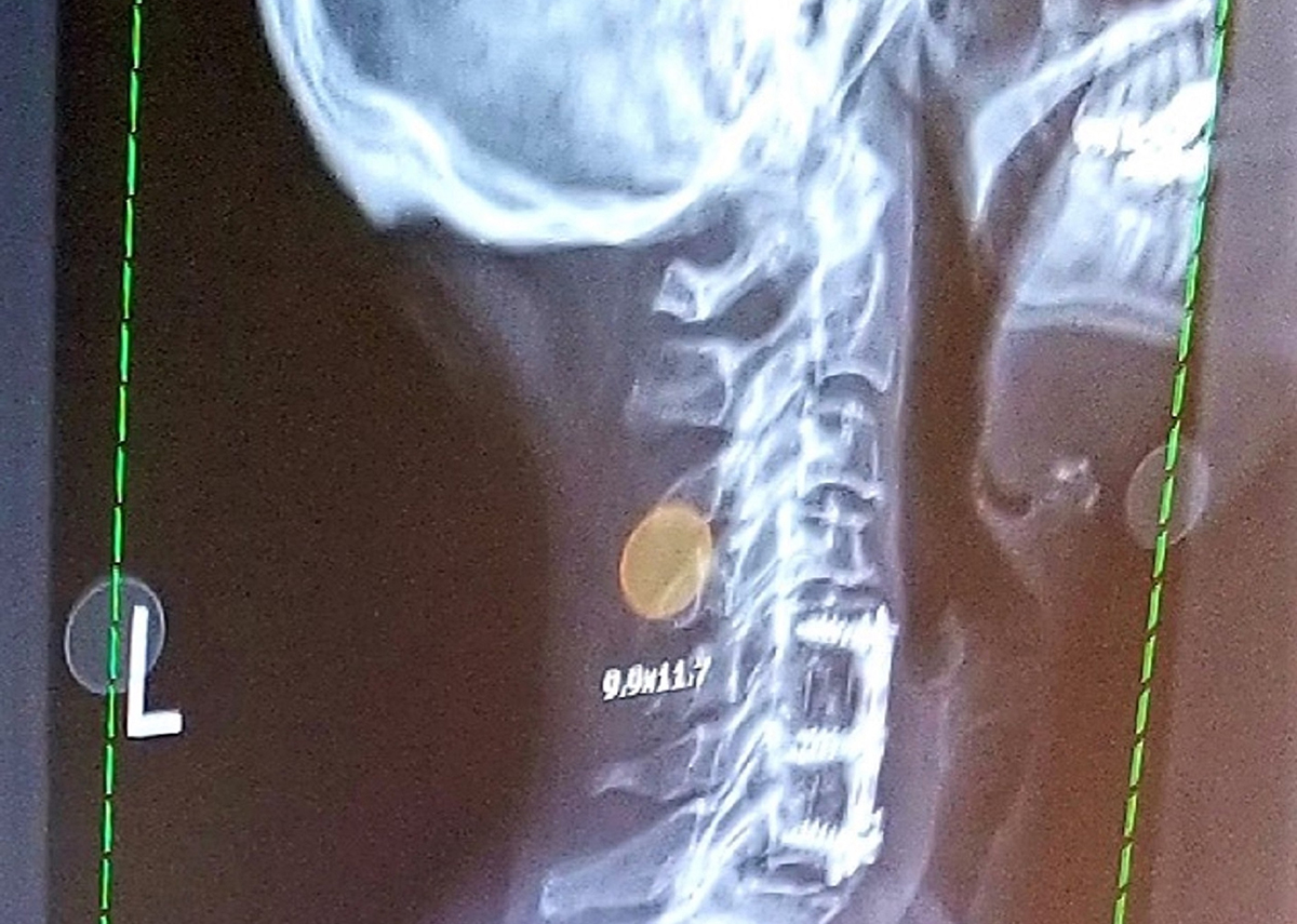 Cervical Spine (Neck) Pain