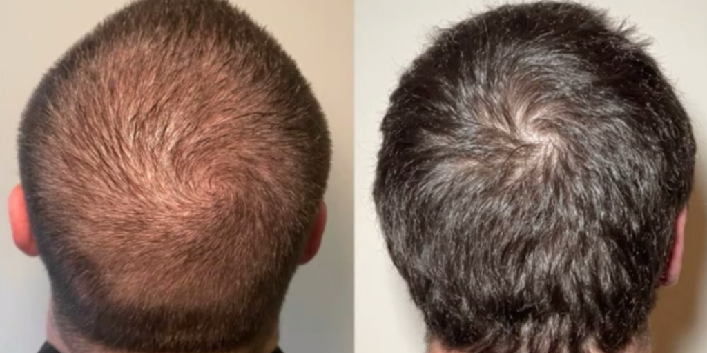 Stem Cell Hair Restoration: Advanced Exosome Treatment