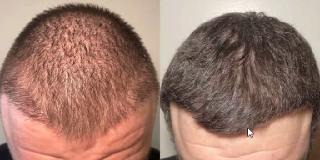 Stem Cell Hair Restoration: Advanced Exosome Treatment